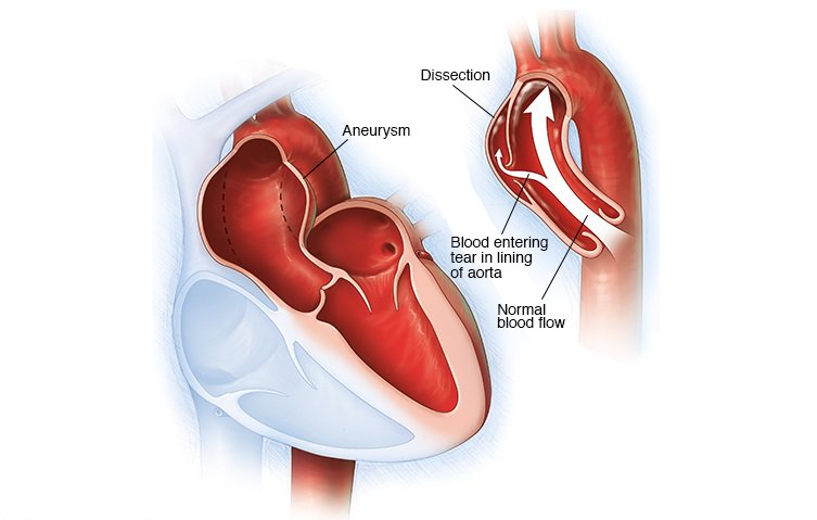 Phình động mạch chủ: Đặt stent graft trong trường hợp nào?