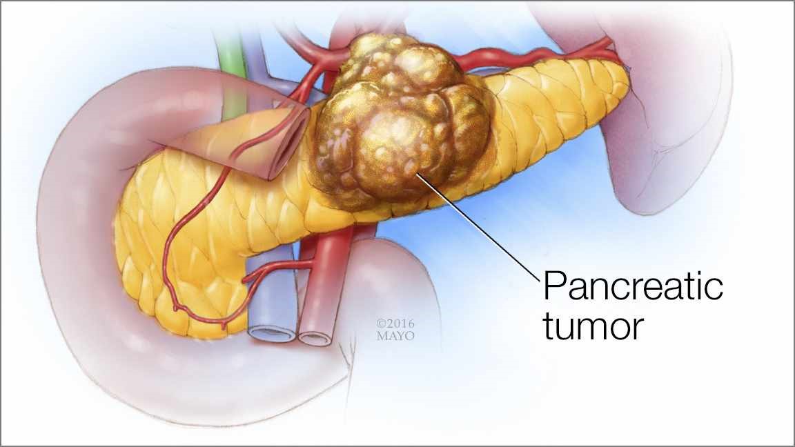 Đề phòng đau bụng thượng vị kéo dài có thể là dấu hiệu của bệnh lý chết người