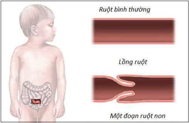 Nhận diện dấu hiệu lồng ruột ở trẻ
