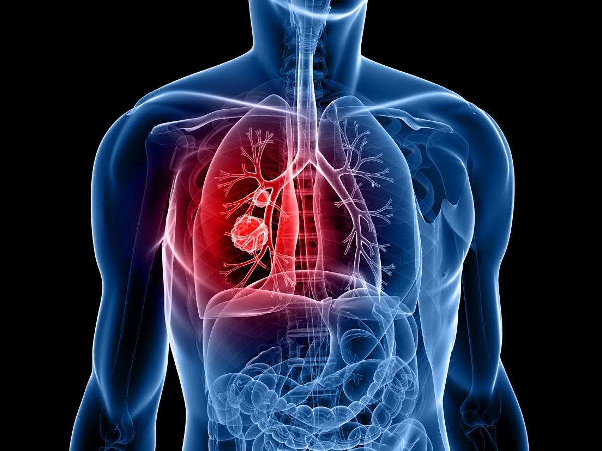 Phát hiện mới về nguyên nhân gây ung thư phổi
