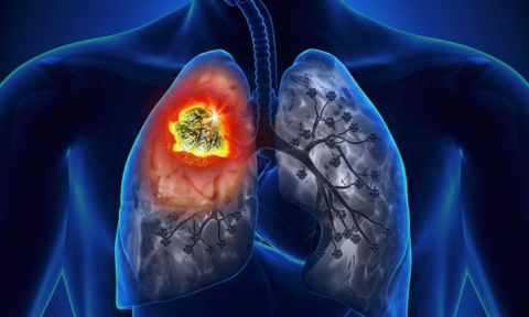 Ung thư phổi 90% khỏi bệnh nếu phát hiện sớm