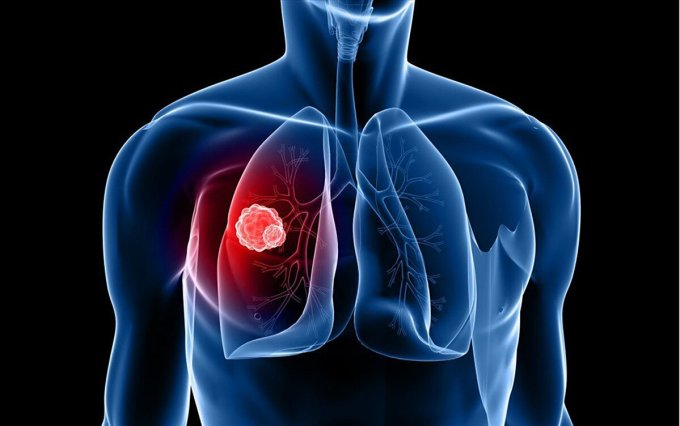 Thuốc ung thư phổi giá 20 tỷ một liệu trình hiệu quả thế nào