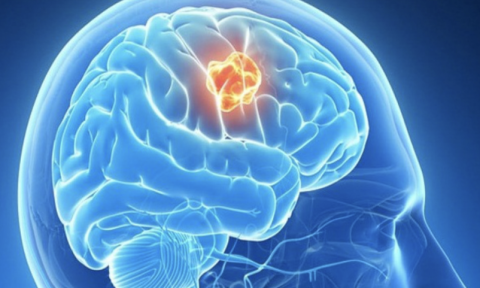 Phát hiện u não từ dấu hiệu đau đầu, nghe kém