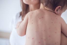 Số ca sởi tăng gấp 22 lần năm ngoái, cả nước cấp tốc tiêm vaccine