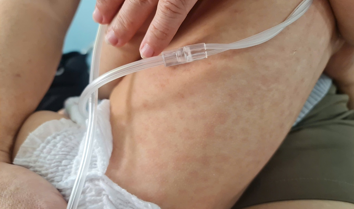 TP HCM bùng dịch sởi, cân nhắc tiêm vaccine cho trẻ từ 6 tháng tuổi