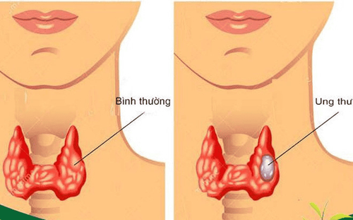 Cách phát hiện và điều trị ung thư tuyến giáp